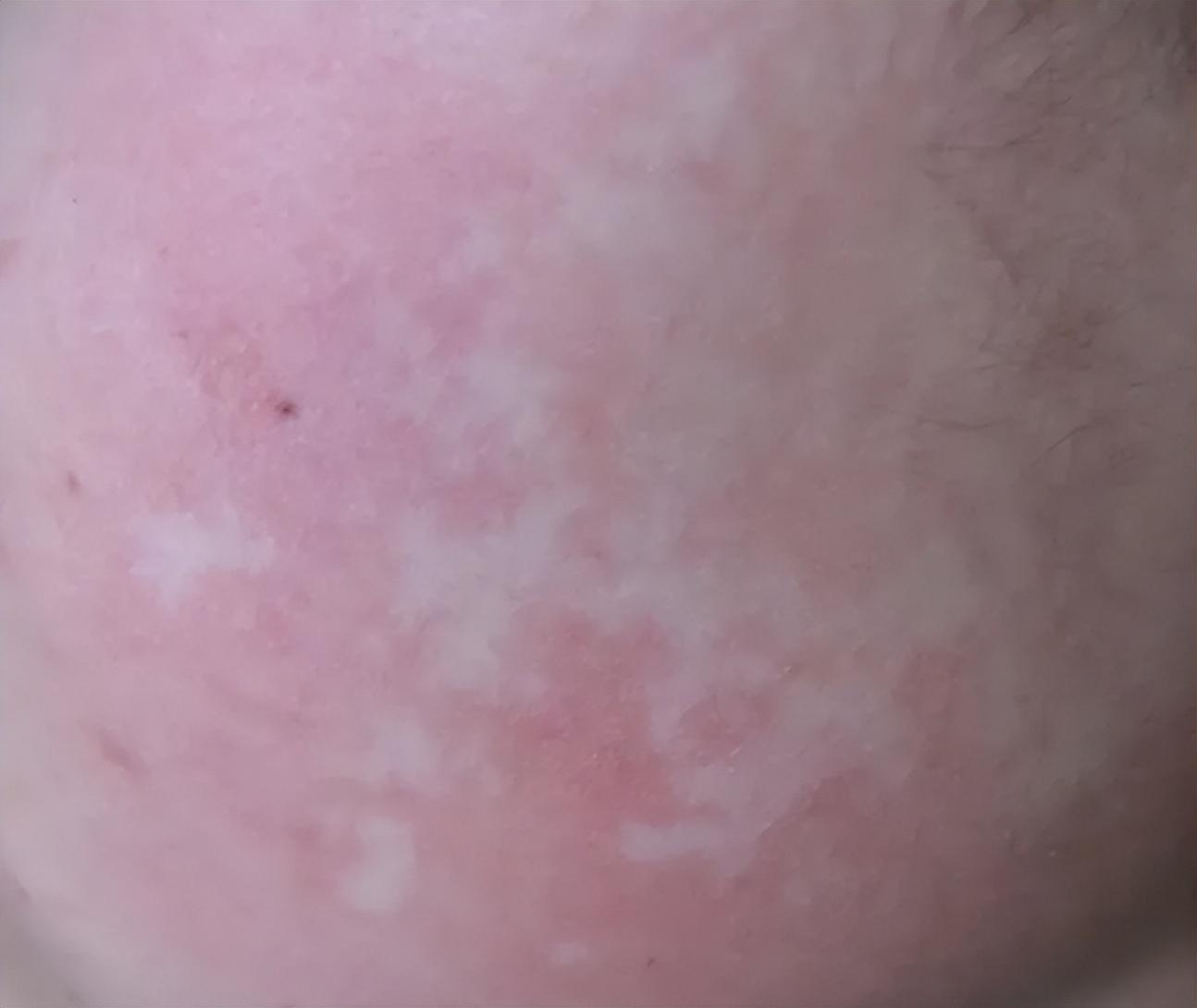 白癜风最新疗法，告别白斑困扰，重塑肌肤光彩！🌟